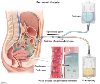 Peritoneal Dialysis