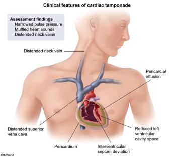 Clinical Features of Cardiac Tamponade