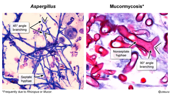 Invasive fungal sinusitis due to mucormycosis zygomycosis